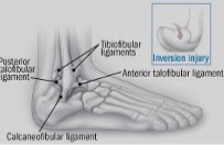 Drawing of sprained foot